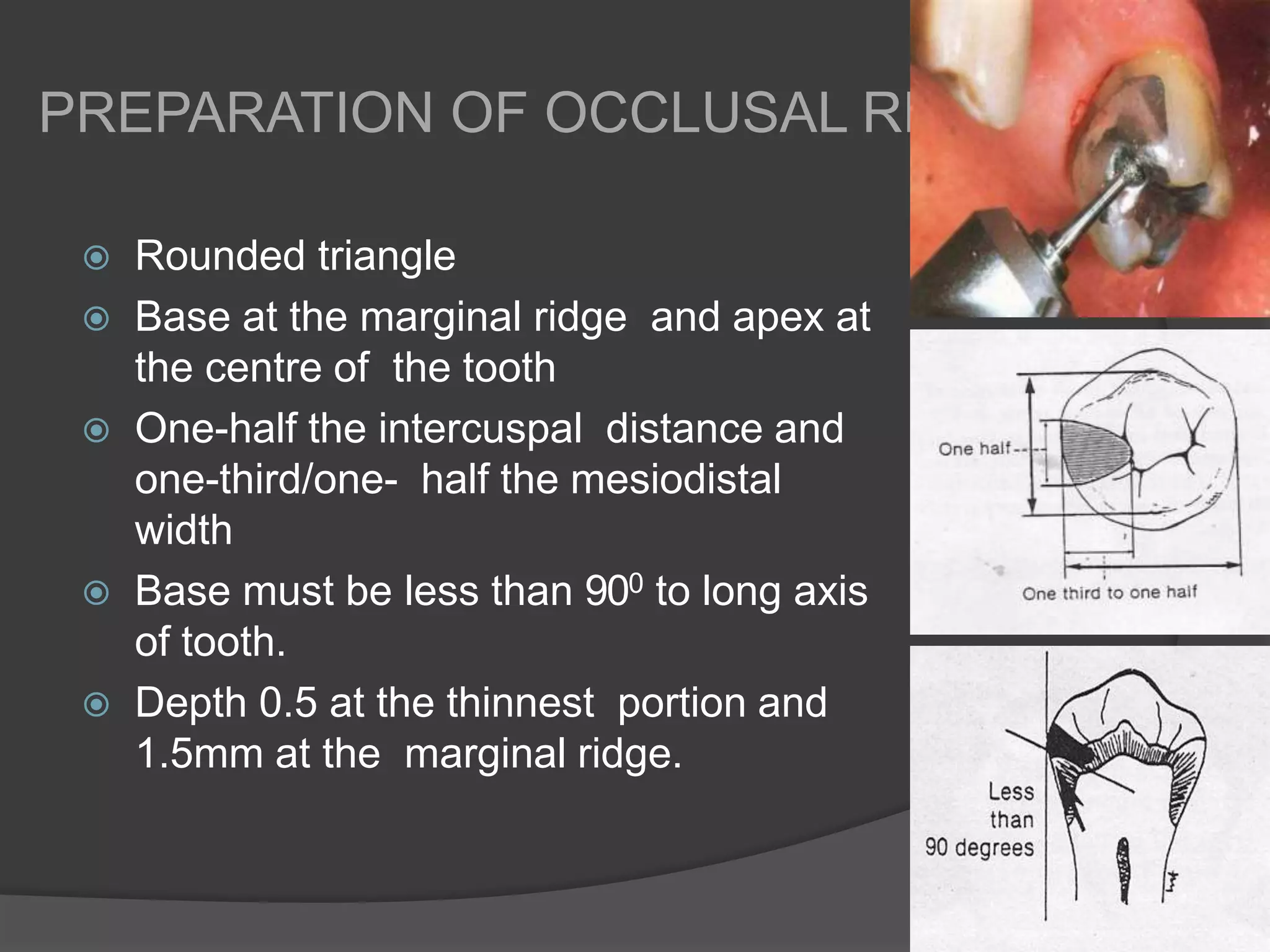 Marginal Ridge Rests INDIRECT RETAINERS IN REMOVABLE PARTIAL DENTURES | PPTX
