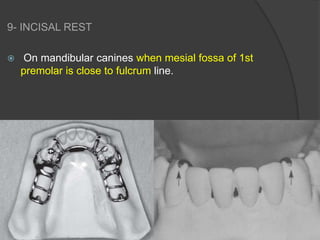 INDIRECT RETAINERS IN REMOVABLE PARTIAL DENTURES | PPTX