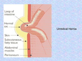 Umbilical Inverted 6 infarction | PPT