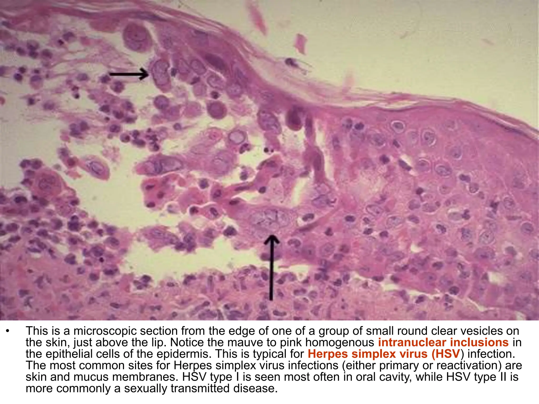 6-INFECTIONS pathology power point presentation | PPT
