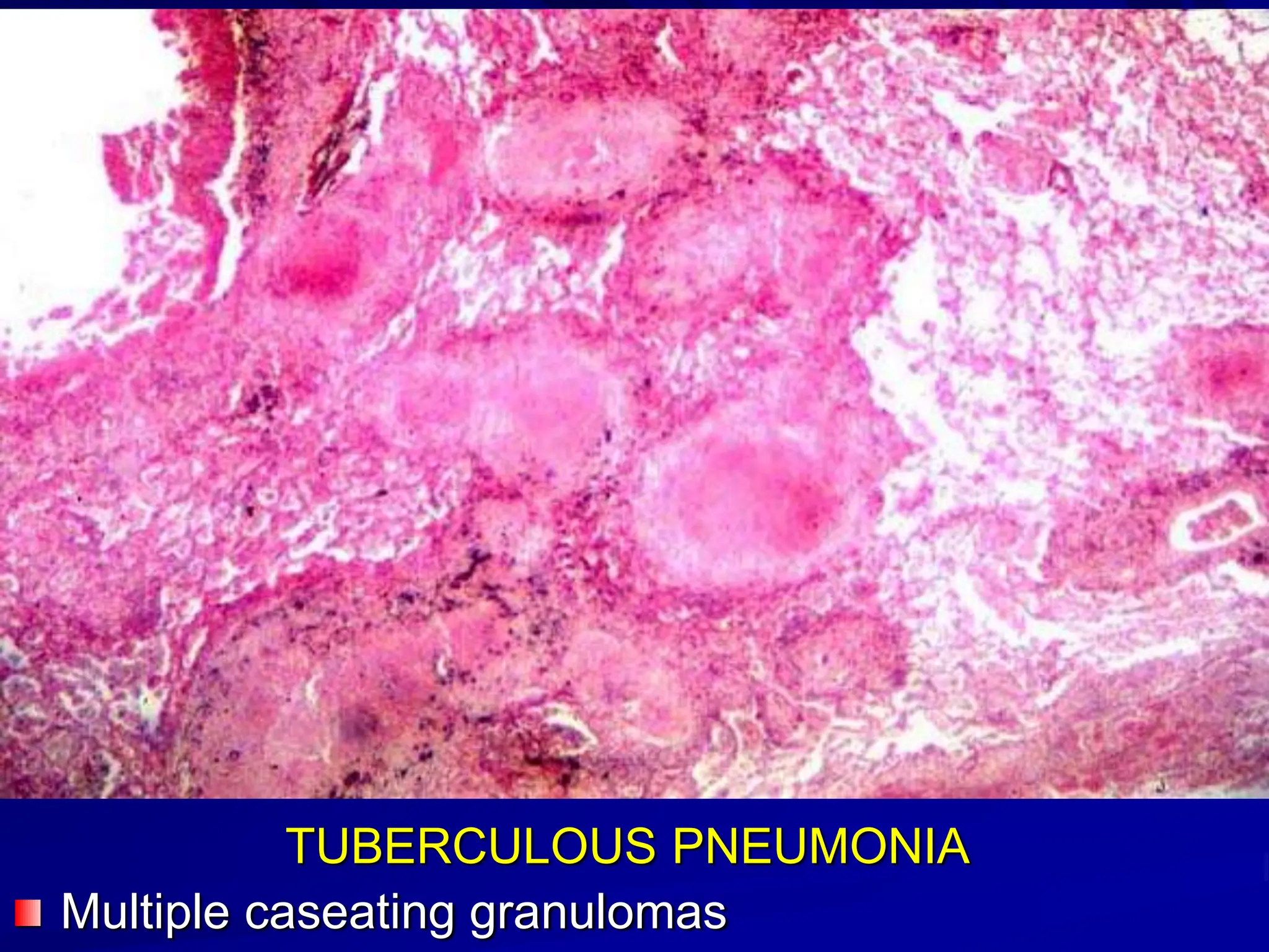 6-INFECTIONS pathology power point presentation | PPT