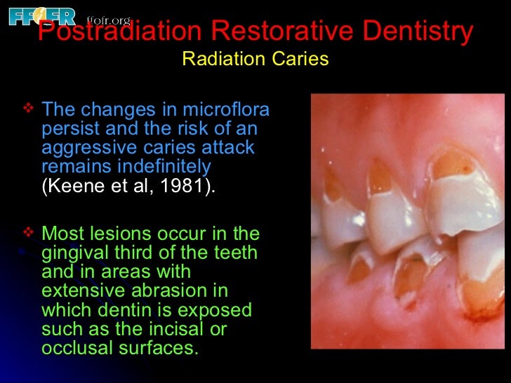 Maintenance, Restorative Care and Postradiation Dental Disease