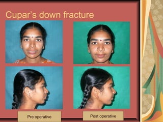 Cupar’s down fracture 
Pre operative Post operative 
 
