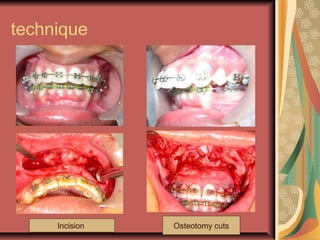 technique 
Incision Osteotomy cuts 
 