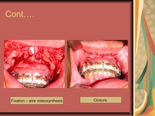 Cont…. 
Fixation – wire osteosynthesis Closure 
 