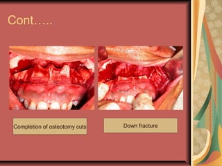 Cont….. 
Completion of osteotomy cuts Down fracture 
 