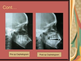 Cont… 
Pre op Cephelogram Post op Cephelogram 
 