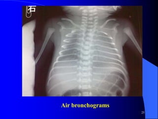 Air Bronchogram Rds 6--NEONATOLOGY NRDS{6}.ppt