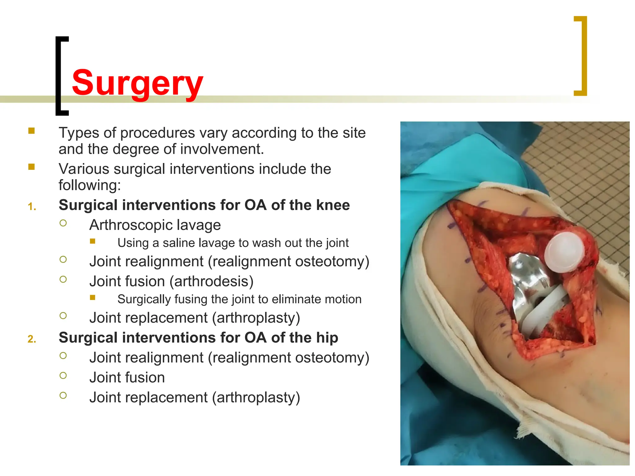 Surgery
 Types of procedures vary according to the site
and the degree of involvement.
 Various surgical interventions include the
following:
1. Surgical interventions for OA of the knee
 Arthroscopic lavage
 Using a saline lavage to wash out the joint
 Joint realignment (realignment osteotomy)
 Joint fusion (arthrodesis)
 Surgically fusing the joint to eliminate motion
 Joint replacement (arthroplasty)
2. Surgical interventions for OA of the hip
 Joint realignment (realignment osteotomy)
 Joint fusion
 Joint replacement (arthroplasty)
102
 