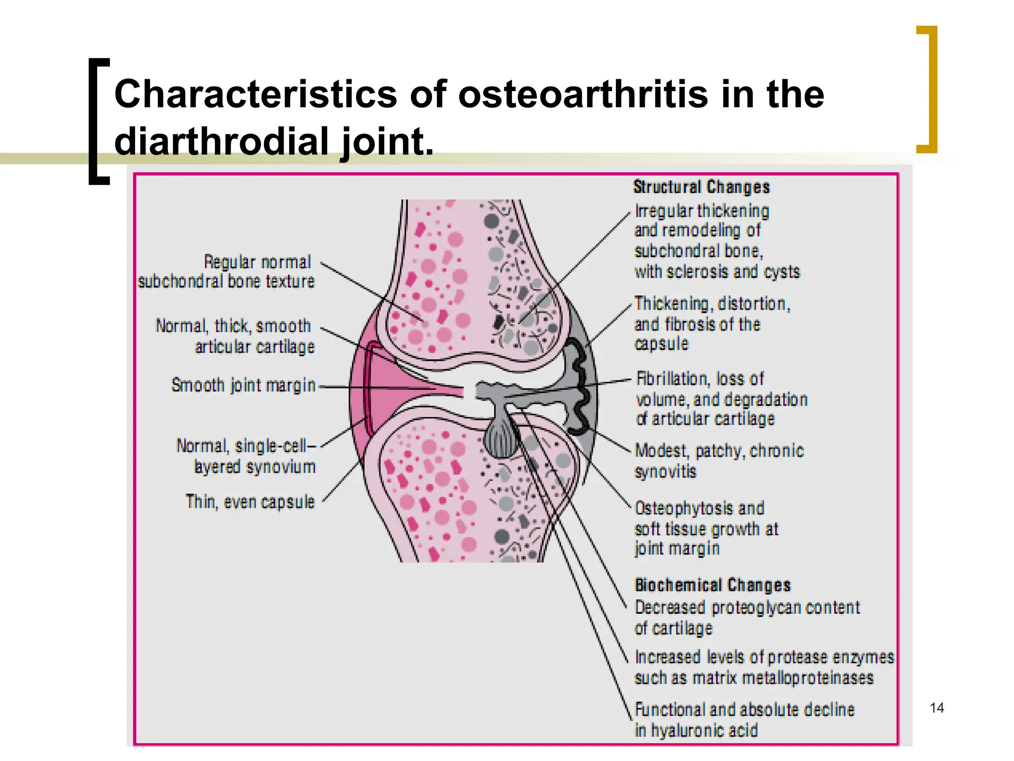 Characteristics of osteoarthritis in the
diarthrodial joint.
14
 