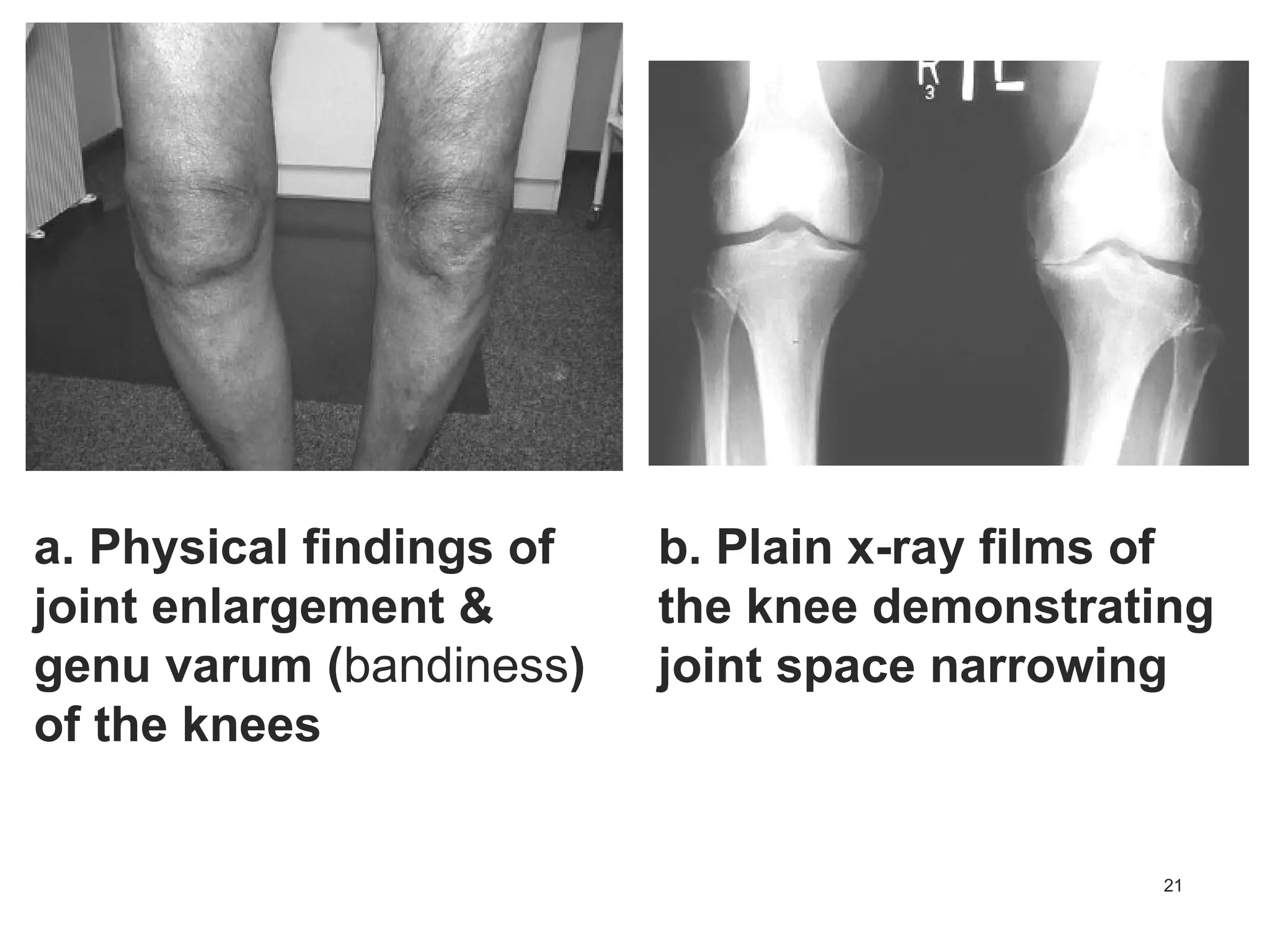21
b. Plain x-ray films of
the knee demonstrating
joint space narrowing
a. Physical findings of
joint enlargement &
genu varum (bandiness)
of the knees
 