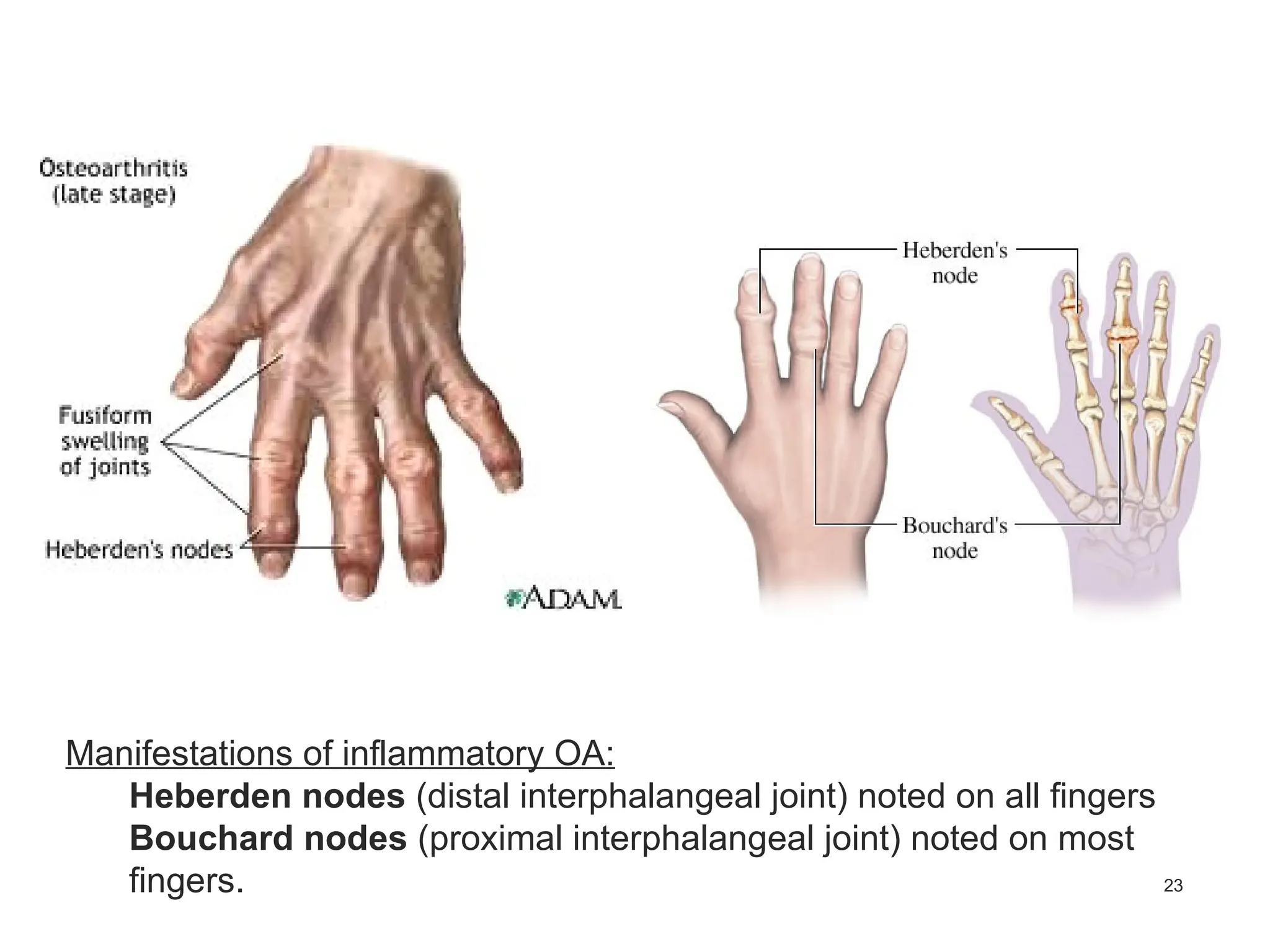 23
Manifestations of inflammatory OA:
Heberden nodes (distal interphalangeal joint) noted on all fingers
Bouchard nodes (proximal interphalangeal joint) noted on most
fingers.
 