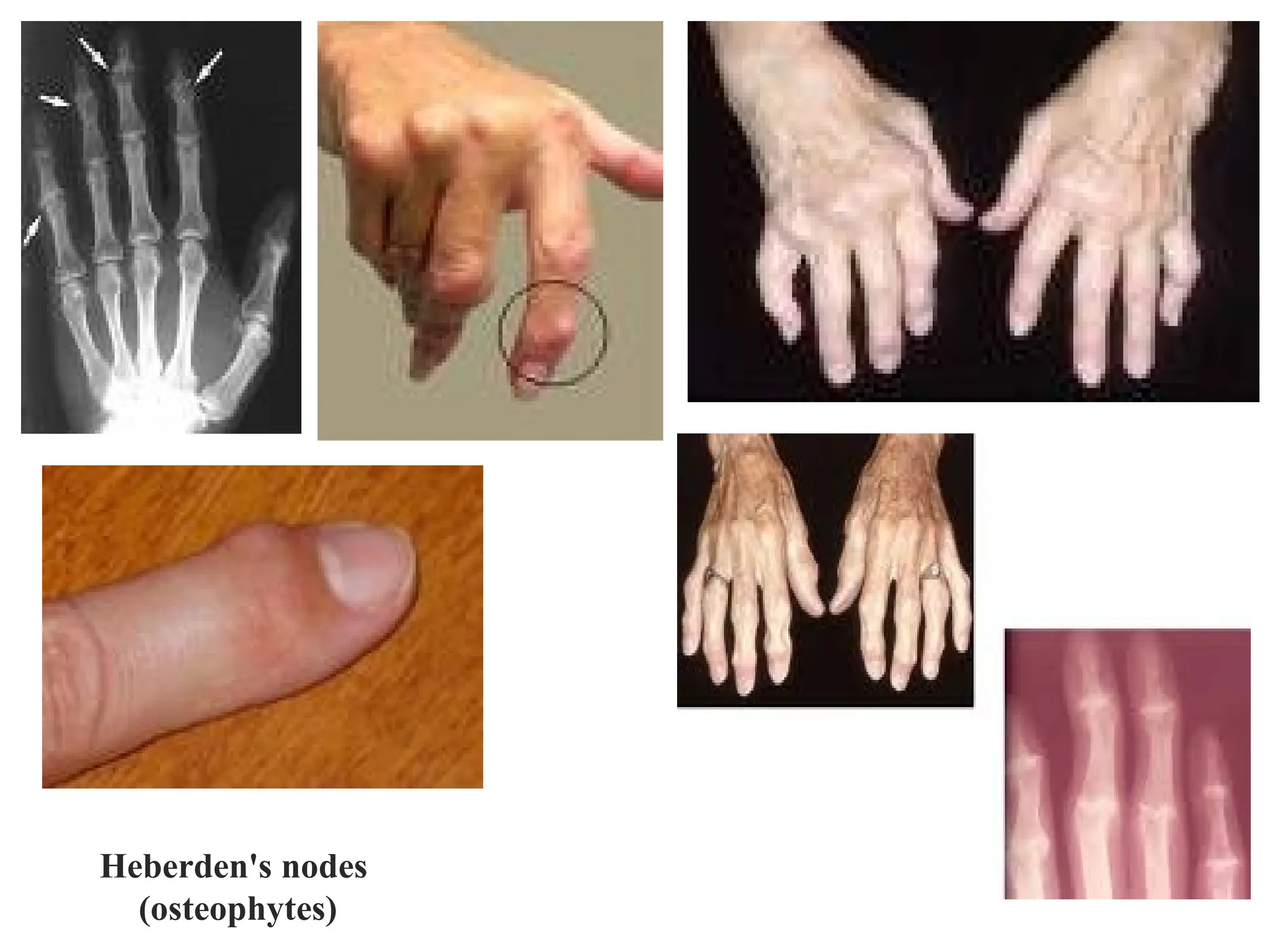 Heberden's nodes
(osteophytes)
 