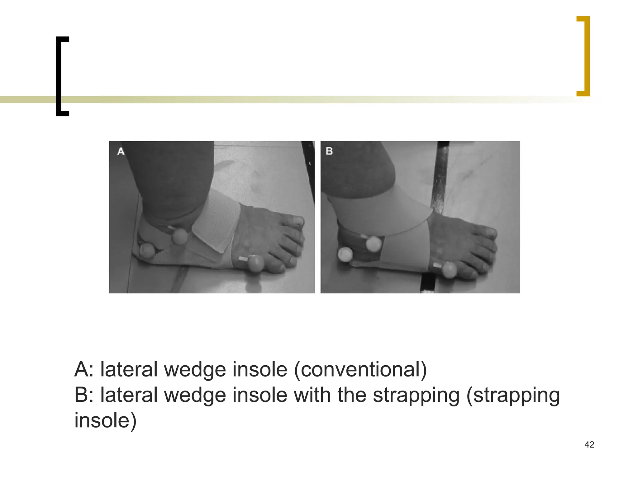 42
A: lateral wedge insole (conventional)
B: lateral wedge insole with the strapping (strapping
insole)
 