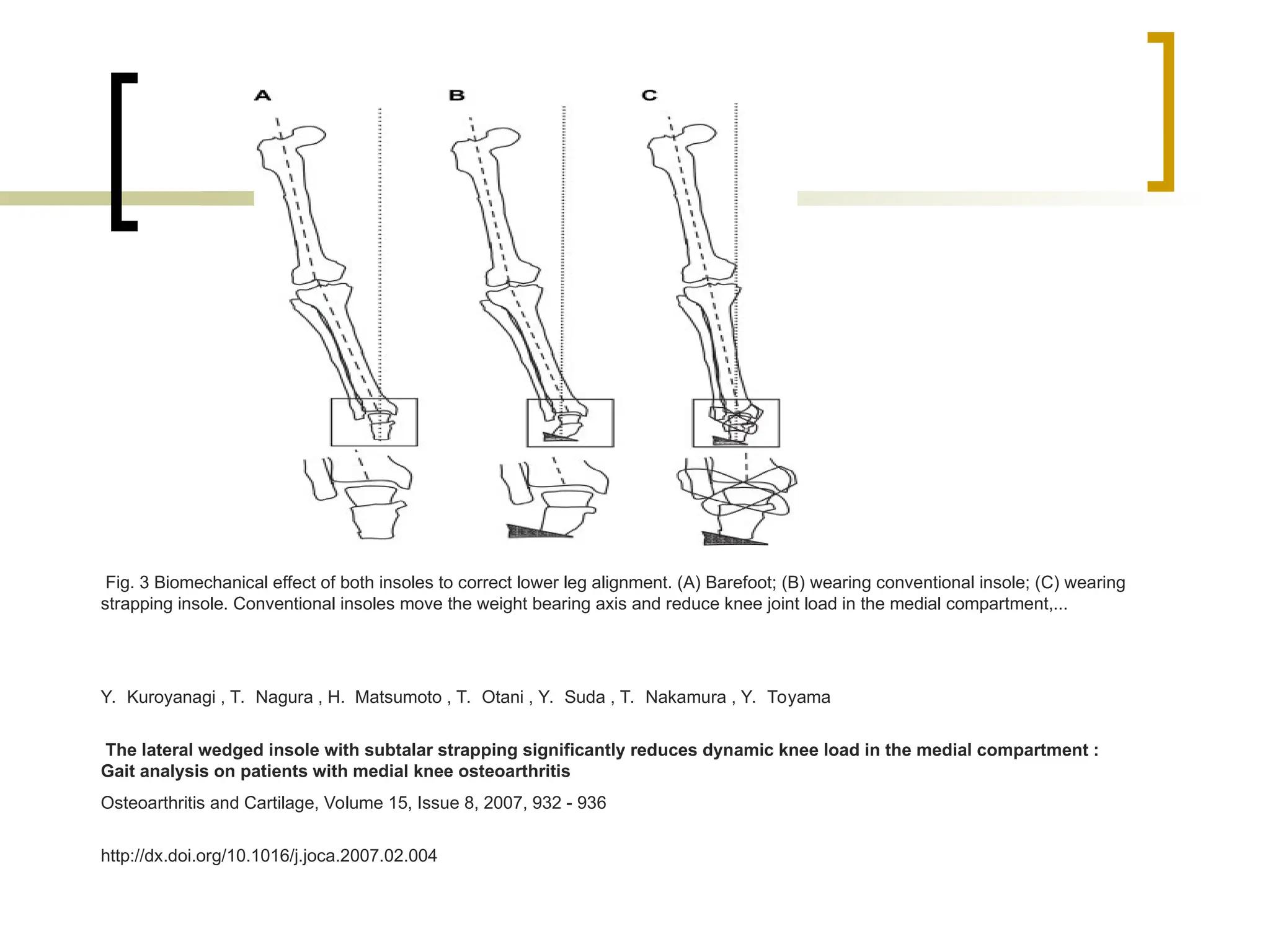 Fig. 3 Biomechanical effect of both insoles to correct lower leg alignment. (A) Barefoot; (B) wearing conventional insole; (C) wearing
strapping insole. Conventional insoles move the weight bearing axis and reduce knee joint load in the medial compartment,...
Y. Kuroyanagi , T. Nagura , H. Matsumoto , T. Otani , Y. Suda , T. Nakamura , Y. Toyama
The lateral wedged insole with subtalar strapping significantly reduces dynamic knee load in the medial compartment :
Gait analysis on patients with medial knee osteoarthritis
Osteoarthritis and Cartilage, Volume 15, Issue 8, 2007, 932 - 936
http://dx.doi.org/10.1016/j.joca.2007.02.004
 