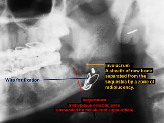 Involucrum
A sheath of new bone
separated from the
sequestra by a zone of
radiolucency.
sequestrum
(radiopaque necrotic bone
surrounded by radiolucent suppuration)
Wire for fixation
 