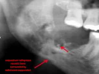 sequestrum radiopaque
necrotic bone
surrounded by
radiolucent suppuration
 