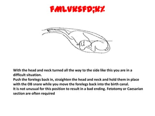 fMLVksfd;k% With the head and neck turned all the way to the side like this you are in a difficult situation.Push the forelegs back in, straighten the head and neck and hold them in place with the OB snare while you move the forelegs back into the birth canal.It is not unusual for this position to result in a bad ending. Fetotomy or Caesarian section are often required