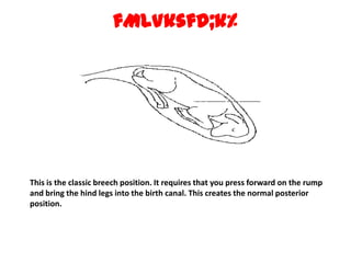 fMLVksfd;k% This is the classic breech position. It requires that you press forward on the rump and bring the hind legs into the birth canal. This creates the normal posterior position. 