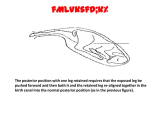 fMLVksfd;k% The posterior position with one leg retained requires that the exposed leg be pushed forward and then both it and the retained leg re-aligned together in the birth canal into the normal posterior position (as in the previous figure). 
