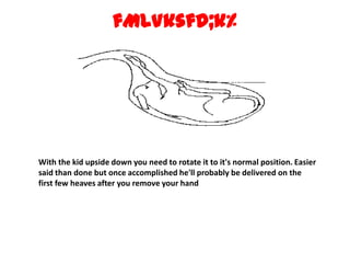 fMLVksfd;k% With the kid upside down you need to rotate it to it's normal position. Easier said than done but once accomplished he'll probably be delivered on the first few heaves after you remove your hand
