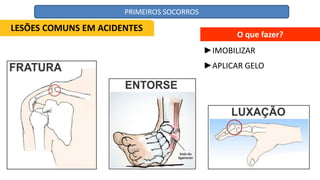 O que fazer?
►IMOBILIZAR
►APLICAR GELO
LESÕES COMUNS EM ACIDENTES
PRIMEIROS SOCORROS
 