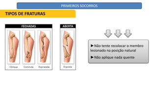 ►Não tente recolocar o membro
lesionado na posição natural
►Não aplique nada quente
TIPOS DE FRATURAS
FECHADAS ABERTA
PRIMEIROS SOCORROS
 
