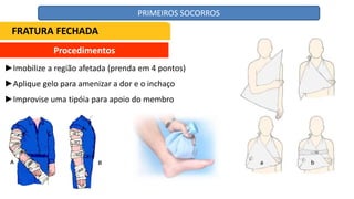 Procedimentos
►Imobilize a região afetada (prenda em 4 pontos)
►Aplique gelo para amenizar a dor e o inchaço
►Improvise uma tipóia para apoio do membro
FRATURA FECHADA
PRIMEIROS SOCORROS
 