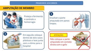 AMPUTAÇÃO DE MEMBRO
PRIMEIROS SOCORROS
 