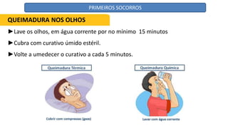 ►Lave os olhos, em água corrente por no mínimo 15 minutos
►Cubra com curativo úmido estéril.
►Volte a umedecer o curativo a cada 5 minutos.
QUEIMADURA NOS OLHOS
PRIMEIROS SOCORROS
 