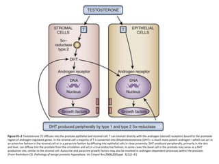 Figure 91–2 Testosterone (T) diffuses into the prostate epithelial and stromal cell. T can interact directly with the androgen (steroid) receptors bound to the promoter
region of androgen-regulated genes. In the stromal cell a majority of T is converted into dihydrotestosterone (DHT)—a much more potent androgen—which can act in
an autocrine fashion in the stromal cell or in a paracrine fashion by diffusing into epithelial cells in close proximity. DHT produced peripherally, primarily in the skin
and liver, can diffuse into the prostate from the circulation and act in a true endocrine fashion. In some cases the basal cell in the prostate may serve as a DHT
production site, similar to the stromal cell. Autocrine and paracrine growth factors may also be involved in androgen-dependent processes within the prostate.
(From Roehrborn CG. Pathology of benign prostatic hyperplasia. Int J Impot Res 2008;20[Suppl. 3]:S11–8.)
 