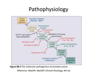 Pathophysiology
Figure 88-5 The molecular pathogenesis of prostate cancer.
Reference: Abeloff: Abeloff's Clinical Oncology, 4th ed.
 