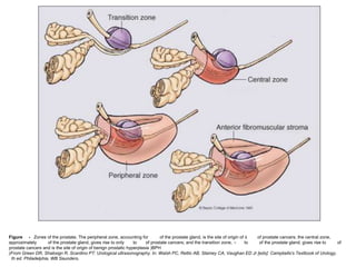 Figure - Zones of the prostate. The peripheral zone, accounting for of the prostate gland, is the site of origin of ≤ of prostate cancers; the central zone,
approximately of the prostate gland, gives rise to only to of prostate cancers; and the transition zone, ∼ to of the prostate gland, gives rise to of
prostate cancers and is the site of origin of benign prostatic hyperplasia (BPH
(From Green DR, Shabsign R, Scardino PT: Urological ultrasonography. In: Walsh PC, Rettic AB, Stamey CA, Vaughan ED Jr [eds]: Campbells's Textbook of Urology,
th ed. Philadelphia, WB Saunders,
 