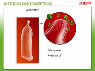 Preservativo
Evita a gravidez
Protege das DST
 