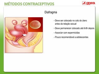 - Deve ser colocado no colo do útero
antes da relação sexual
- Deve permanecer colocado até 6-8h depois
- Associar com espermicidas
- Pouco recomendável a adolescentes
Diafragma
 