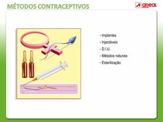 - Implantes
- Injectáveis
- D.I.U.
- Métodos naturais
- Esterilização
 