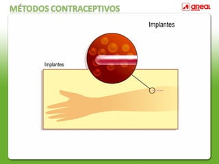Implantes
Implantes
 