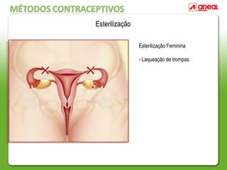 Esterilização Feminina
- Laqueação de trompas
Esterilização
 