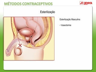 Esterilização
Esterilização Masculina
- Vasectomia
 