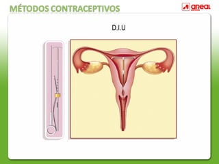 D.I.U
 