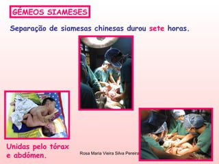 GÉMEOS SIAMESES Separação de siamesas chinesas durou  sete  horas. Unidas pelo tórax e abdómen. 