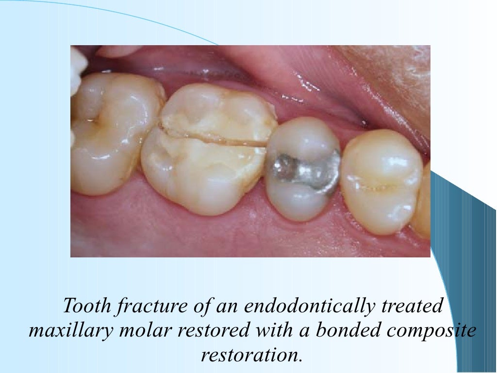 6.restoration of the endodontically treated tooth