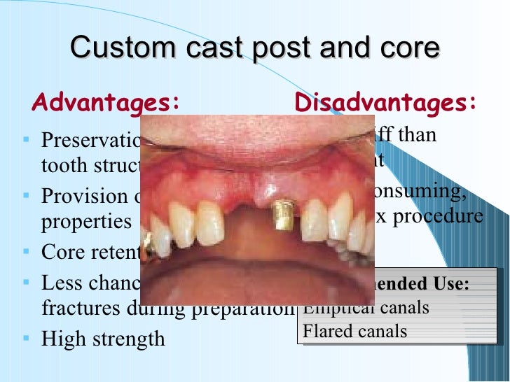 cast post and core