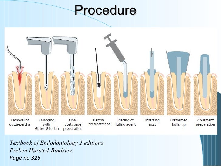 6.restoration of the endodontically treated tooth
