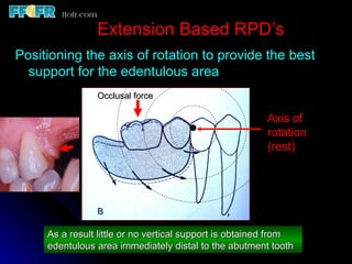 Tissue Ward Rotation Rpd 6.rpd design philosophies | PPT