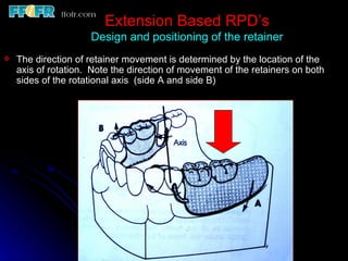 Rotational Rpd 6.rpd design philosophies | PPT