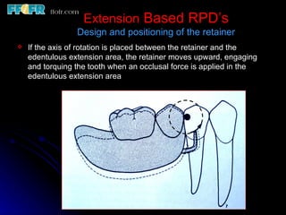 Rotational Rpd Retainer 6.rpd design philosophies | PPT