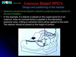 Rotational Rpd Retainer 6.rpd design philosophies | PPT