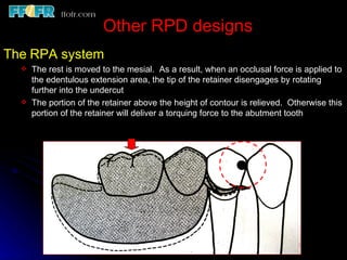 Continuous Rest Rpd 6.rpd design philosophies | PPT