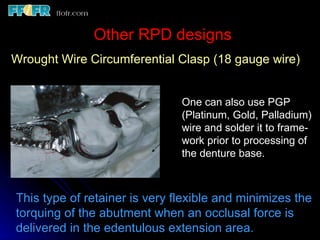 Wrought Wire Rpd 6.rpd design philosophies | PPT
